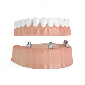 Implantatgetragene Prothese bei zahnlosem Kiefer Implantatgetragene Prothese bei zahnlosem Kiefer
